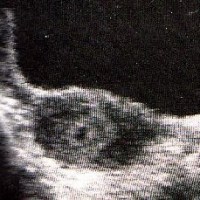 Texas: obbligo di ecografia prima dell'aborto.